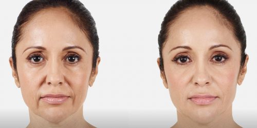 Unretouched photos of Abbey taken before treatment and 2 weeks after treatment. A total of 3.2 mL of JUVÉDERM® XC was injected into the parentheses, marionette, and corner lines.