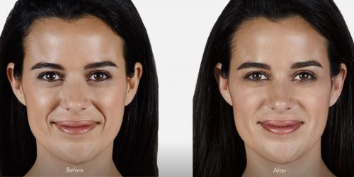 Unretouched photos if Karla taken before treatment and 2 weeks after treatment. A total of 2.3 mL of JUVÉDERM VOLLURE™ XC was injected in the parentheses, corner and marionette lines.