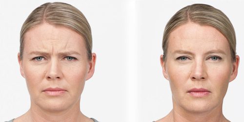 Photo of Marianne taken at maximum frown and/or full smile before and after treatment with BOTOX® Cosmetic at day 7.