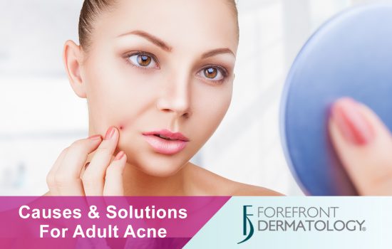 Causes and Solutions for Adult Acne