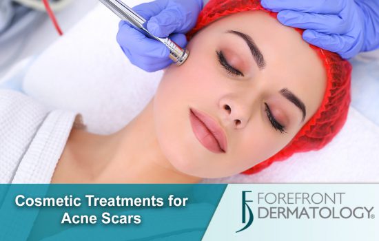 Cosmetic Treatments for Acne Scarring