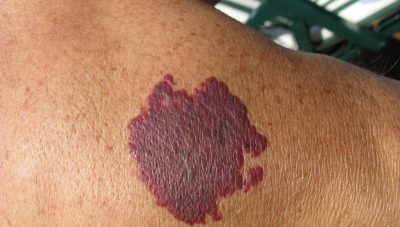 When to Consider Birthmark Removal