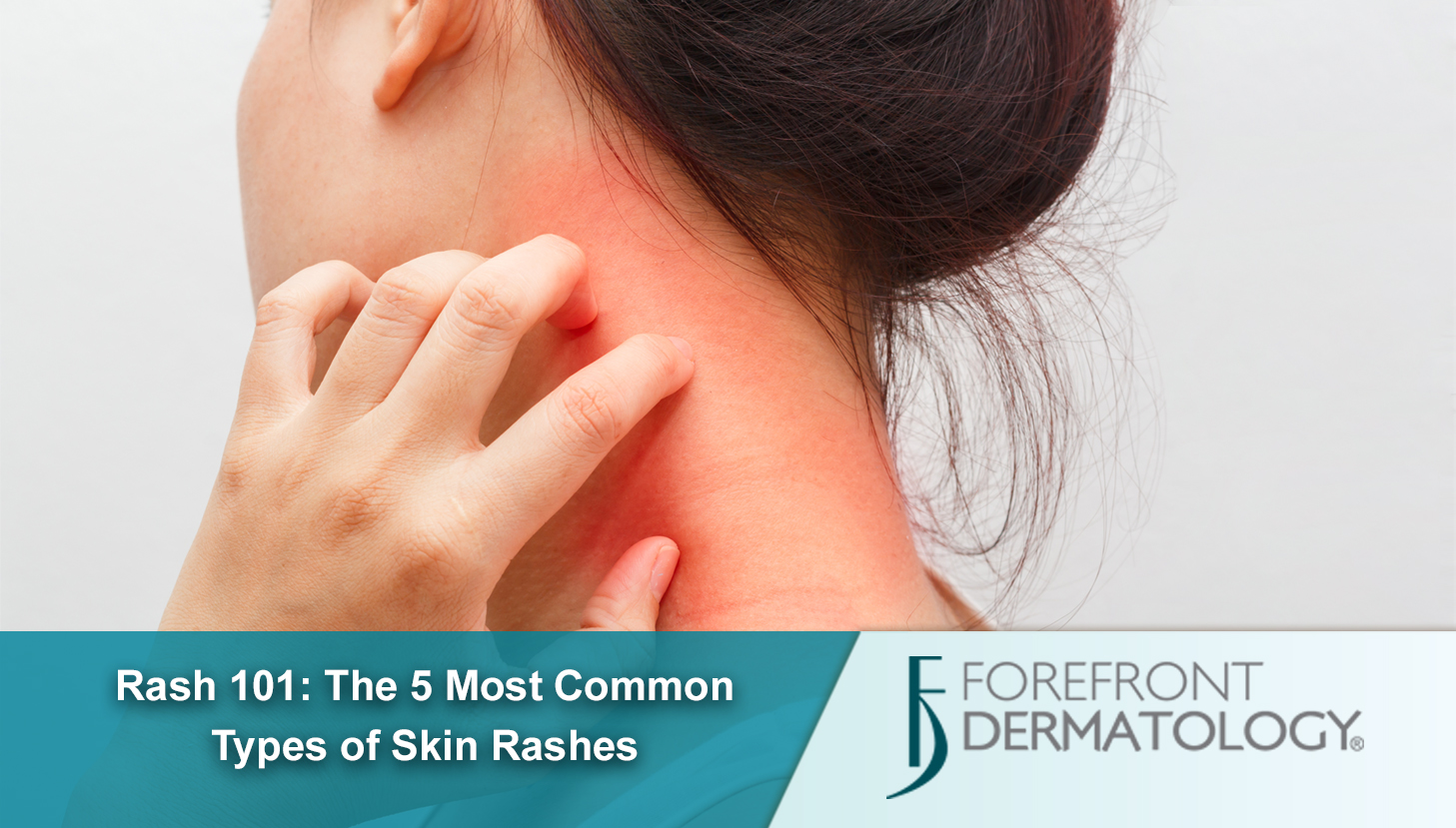 Rash 101 The 5 Most Common Types Of Skin Rashes Dermspecialists