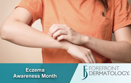 Eczema 101 : Get the Facts