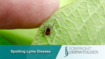 Lyme Disease and Your Skin