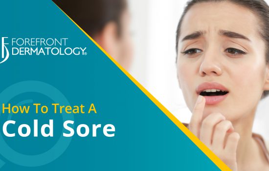 How to Treat a Cold Sore