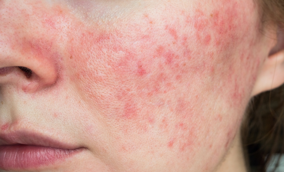 Rosacea Treatment By A Dermatologist Dermspecialists Ky